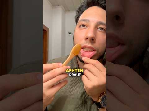 3 Hausmittel gegen Aphten (Entzündung im Mund)👄