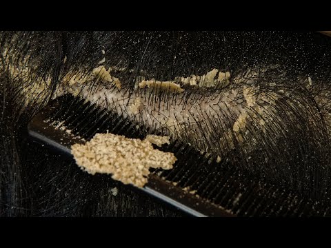 Satisfying Scalp Dandruff Removal: Comb Scratching Big Flakes #DKMOR2717