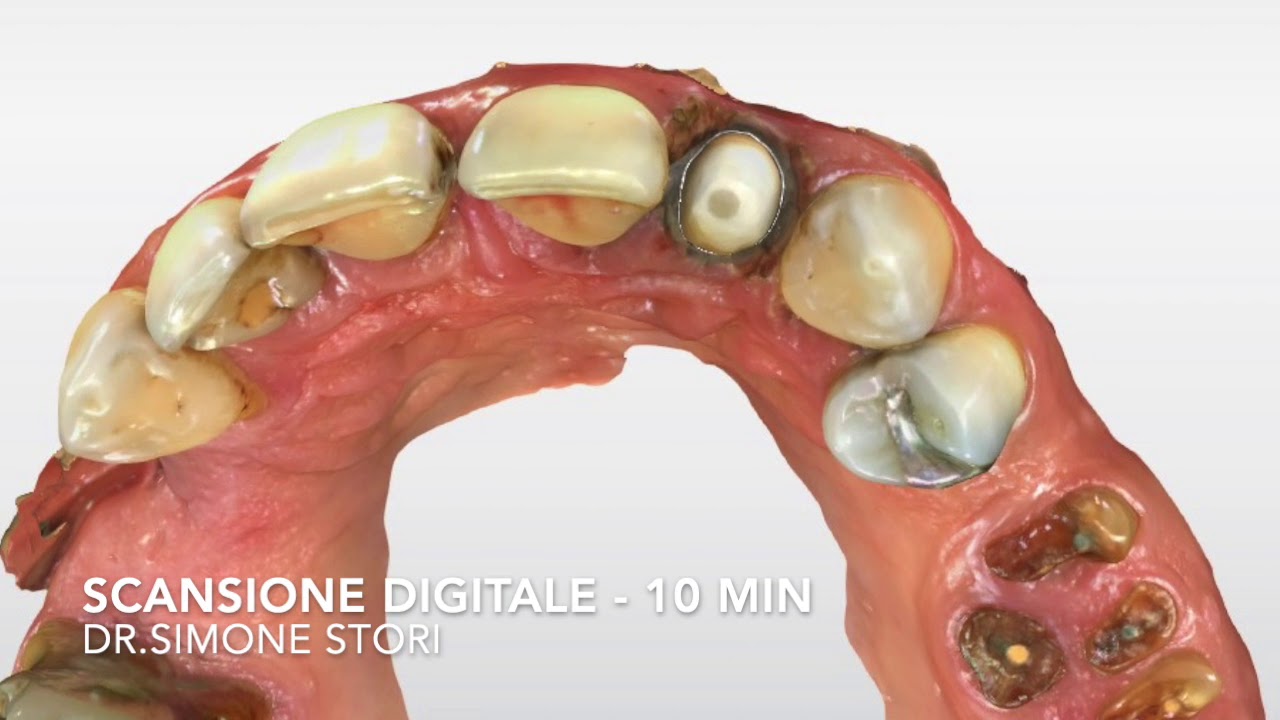 Watch Now Dente Nuovo in 2 ore Ecco come recuperare un dente con la Protesi Digitale Immediata a Bologna. Dente Nuovo in 2 ore Ecco come recuperare un dente con la Protesi Digitale Immediata a Bologna.