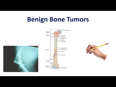 Benign Bone Tumors Made Simple