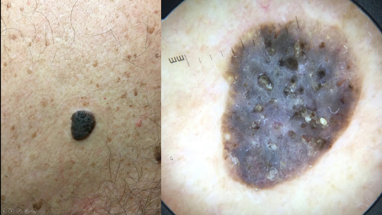 Melanomas que simulan queratosis seborreicas por la dermatoscopia