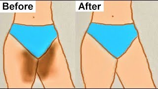 How to Lighten Your Private area Naturally At Home, Lighten Dark Private Body Parts