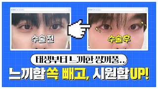 느끼했던 쌍꺼풀... 아이컨텍 절개눈매교정 후 자연스럽고 시원한 눈매 완성! ㅣ아이컨텍성형외과ㅣ남자눈성형ㅣ절개눈매교정