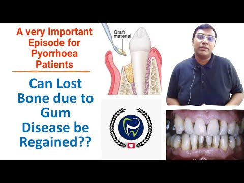 Dr Rudra Mohan | Can Bone Loss due to Gum Disease Be Reversed ? Is Periodontal Disease Reversible ?