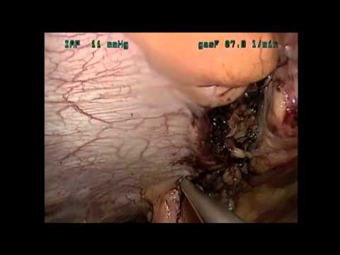 Transvaginale laparoskopische Nabelbruch-OP