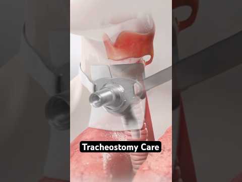 Tracheostomy Care (3D Animation)