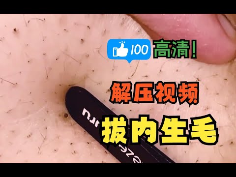 毛囊倒生