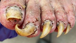 The Complete Process Of Trimming Onychomycosis Nails! Removing The Fungus One By One!【Xue Yidao】