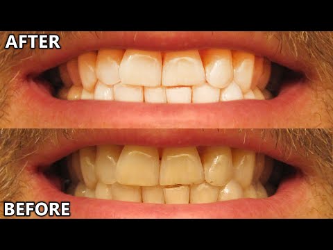 Crest Whitestrips RESULTS Test Review WOW!!! 3D Classic Vivid teeth whitening kit
