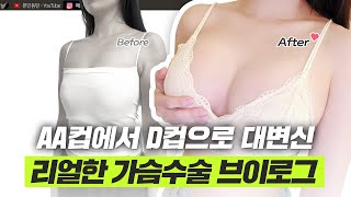 AA컵에서 D컵으로 바뀐 가슴수술 브이로그 리얼 후기!ㅣ디에이성형외과ㅣ디에이성형외과의원