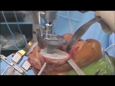 Una serie di esercizi per la divulgazione delle articolazioni dellanca Sensazione di freddo in osteocondrosi