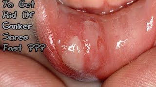 How To Get Rid Of Canker Sores Fast - Get Rid Of Canker Sores (Party 1)