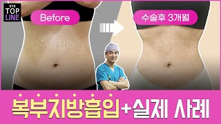 복부지방흡입 [실제 사례] - 전후 사례 분석