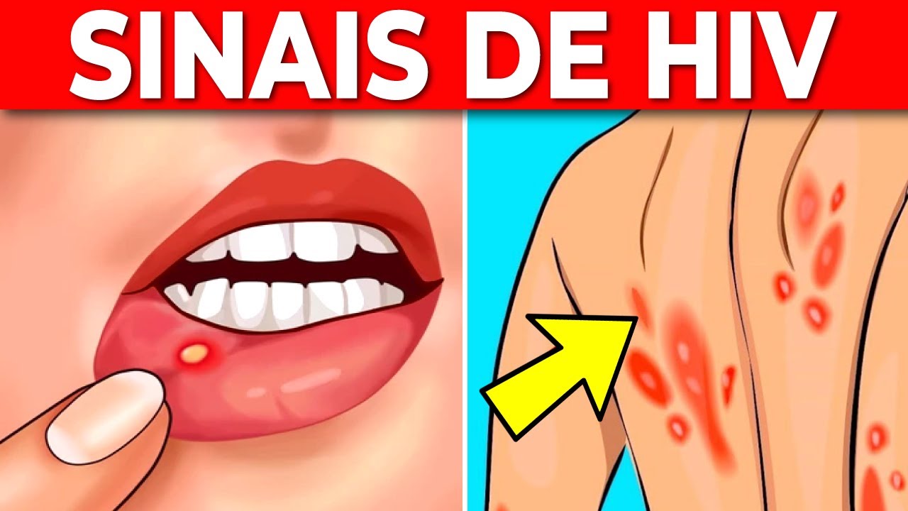 10 Sintomas Que Você Está Infectado pelo HIV
