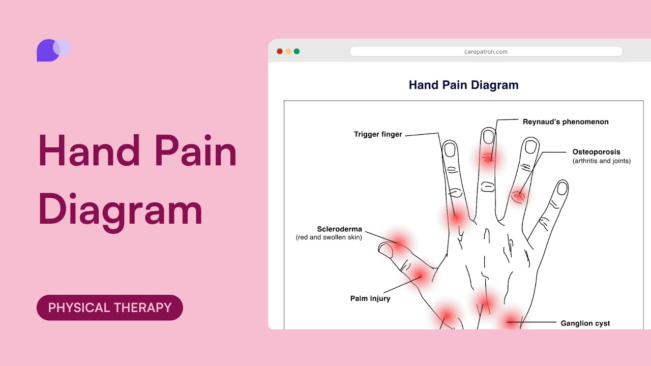 Hand Pain Diagram