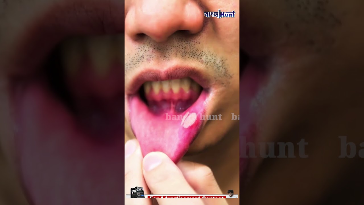 মুখের ভিতর ফুসকুড়ি বার বার ফিরছে? ঘাবড়াবেন না, কারণ আর সমাধান জেনে নিন ?