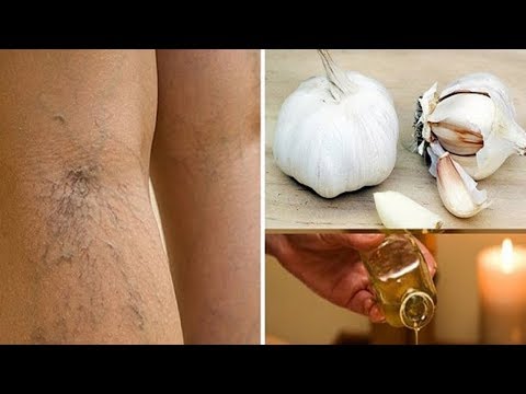 , title : 'Using garlic with honey to rub properly, varicose veins are also very quick'