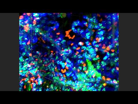 PLISH In situ hybridization of thick human lung tissue For SFTPC, MIR29-1, and AXIN2