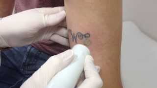 preview picture of video 'Remoção de Tatuagem a laser em Vila Velha - ES pela Dra Marcela Staut 27-98314603'