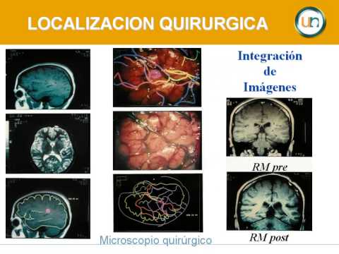 Neuronavegación en Neurocirugía