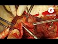 Penoplasty