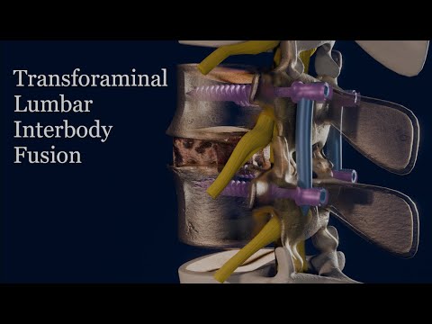 Transforaminal Lumbar Interbody Fusion