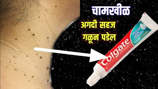 असा कोलगेट लावा चामखीळ सहज गळून पडेल ! Chamkhil gharguti upay , how to remove skin tag