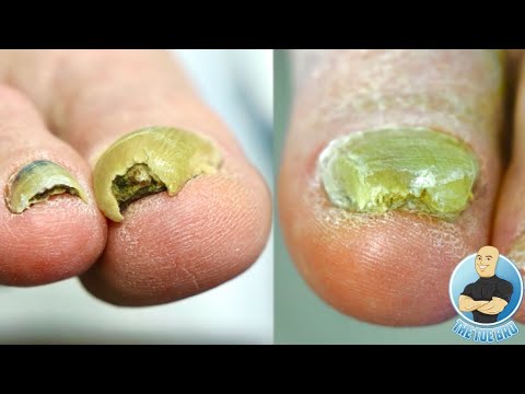 CUTTING AND TRIMMING SUPER THICK TOENAILS!!! ***HOW TO MANAGE HARD TO CUT TOENAILS***