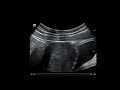 Utilizing A Linear Probe For Early IUP Confirmation