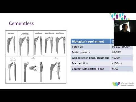 OrthoFracs THR fixation method in patients less than 65 years old by Dr. Lachlan Wight