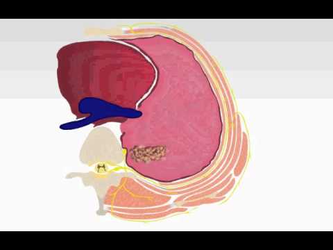 comment soulager les douleurs des metastases osseuses