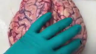 Intracerebral haemorrhage discovered during brain autopsy!