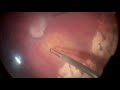 Vitrectomy In Stage IVB ROP