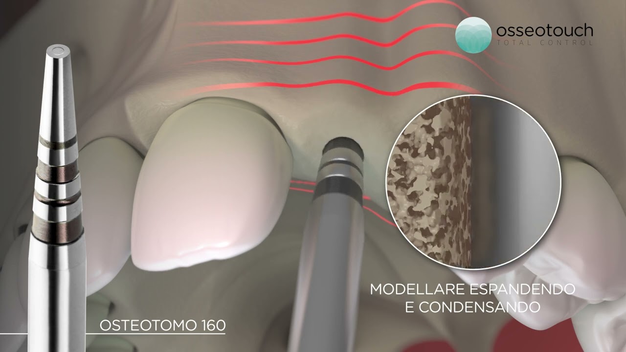 Animazione 3D First OSSEOTOUCH — Ingaggio della cresta drills-free