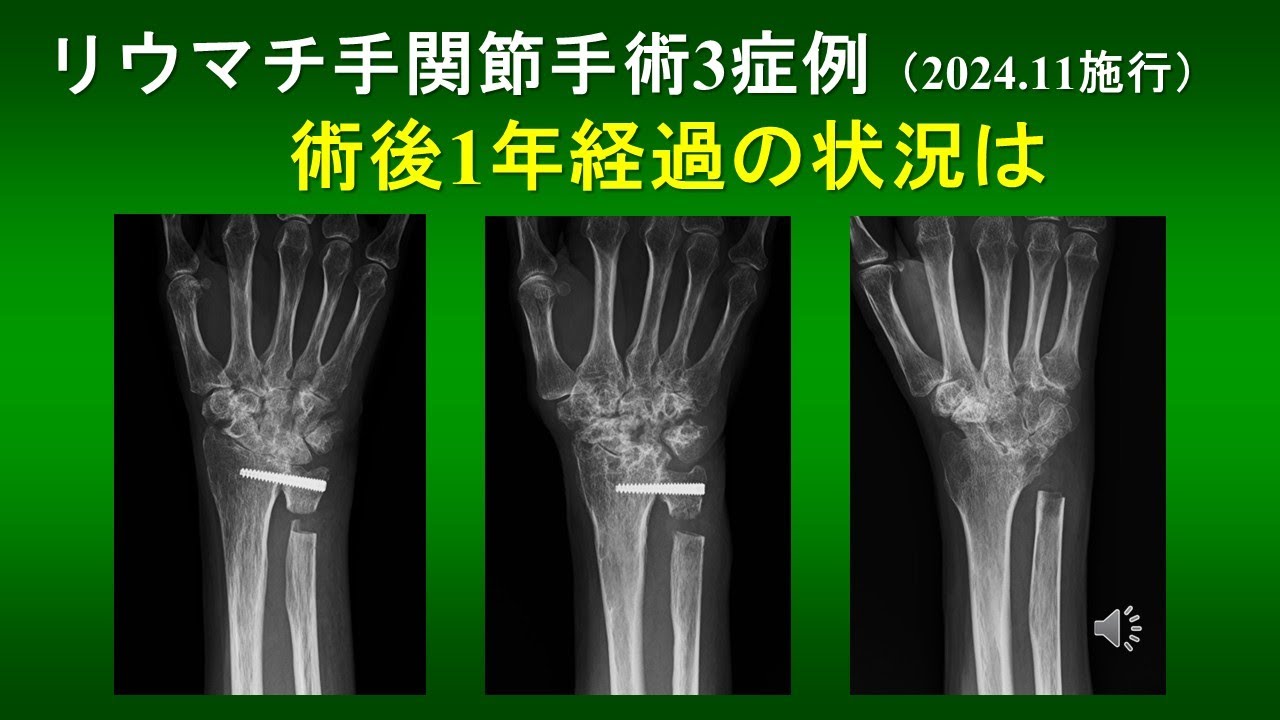 リウマチ手関節手術3症例　（2024年11月施行）術後1年経過の状況