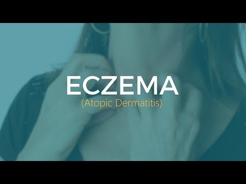 What To Do If You Have Eczema (Atopic Dermatitis)