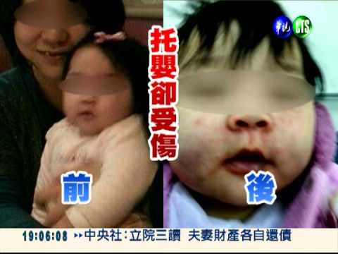 合格保母虐嬰? 7月娃臉腫聽力損