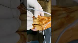 Radiofrecuencia para el Neuroma de Morton