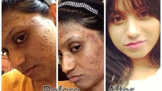 DIY How To Get Rid Of Acne FAST !  Home Remedy : Acne + Allergic Reaction To Flawless Skin