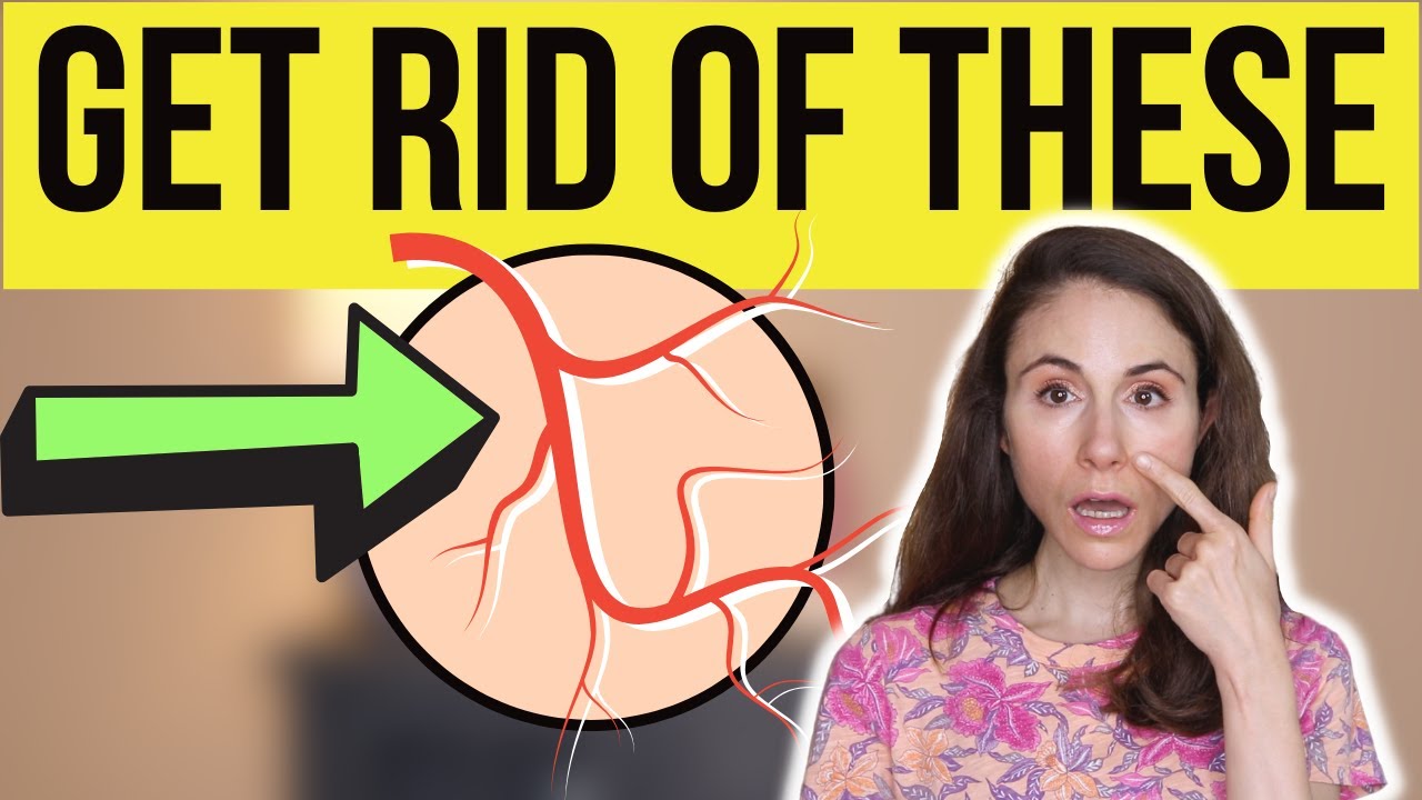 How long do popped blood vessels on face take to heal? More REF