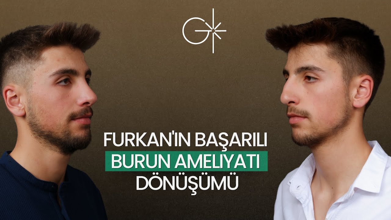 Furkan'ın Rinoplasti Burun Estetiği Süreci 1.5 Yıl Sonucu
