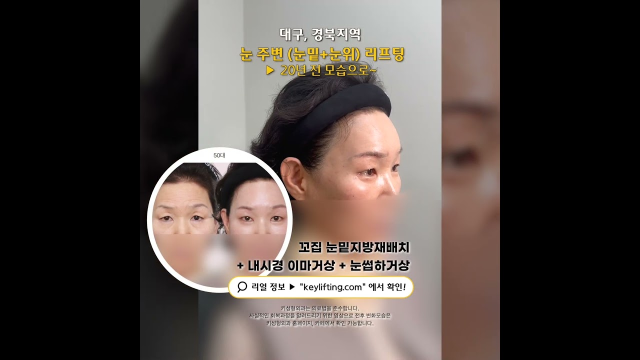 대구 눈밑+눈꺼풀 리프팅