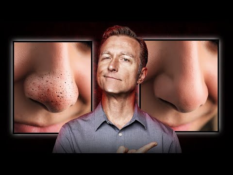 Which Vitamin Deficiency Causes Chapped Cracked Lips – Dr Berg