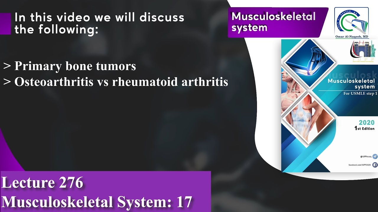 Primary bone tumors | Osteoarthritis vs rheumatoid arthritis