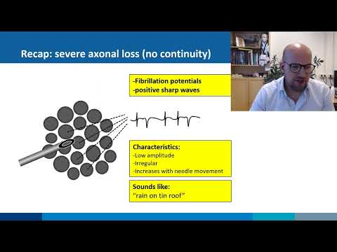 Needle EMG: spontaneous muscle fiber activity