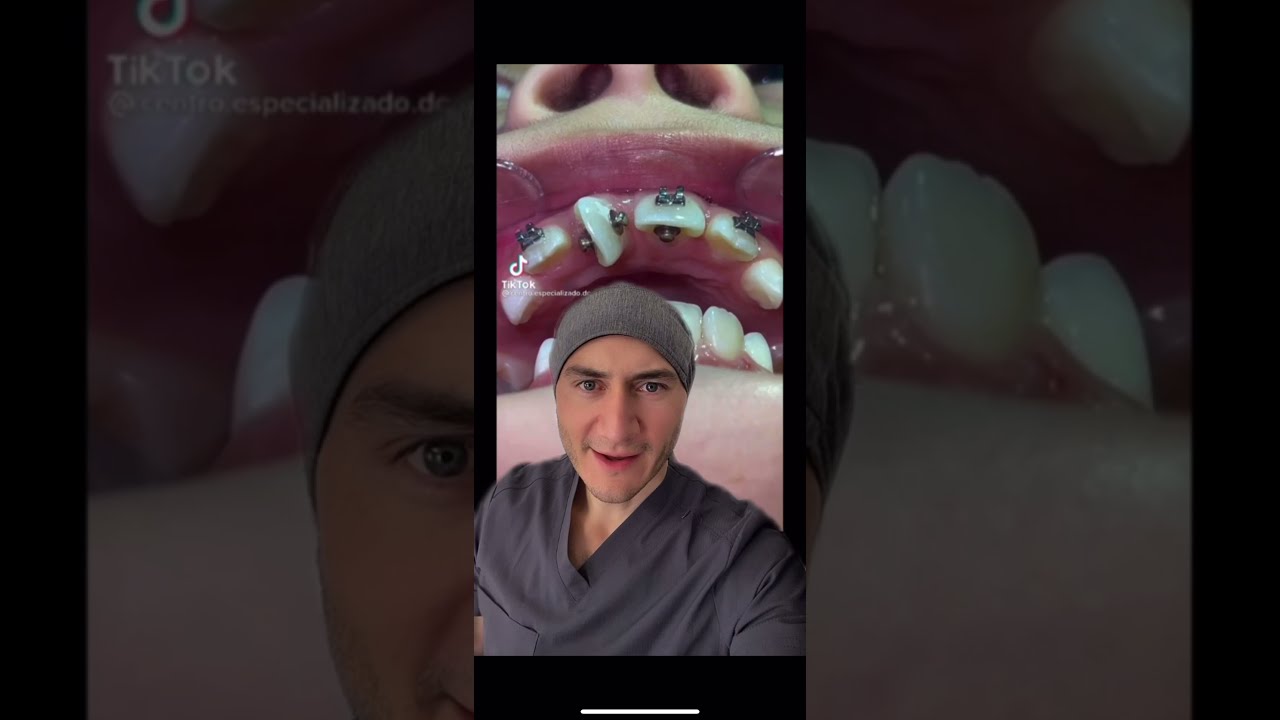 ¿Acaso tiene solución este diente tan girado La maravilla de los brackets #shorts