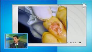 Los dedos en garra: tratamiento conservador y quirúrgico por Podologo Malaga