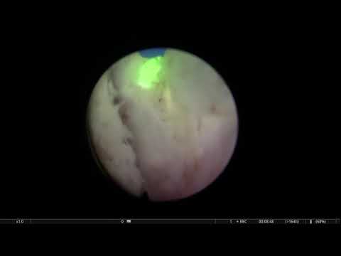 Real-life HoLEP 22: Low Power Holmium Laser In A Patient With Many BPH Nodules