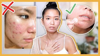 15 skincare habits that improved my skin/acne