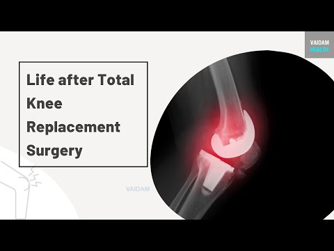 Life after Total Knee Replacement surgery